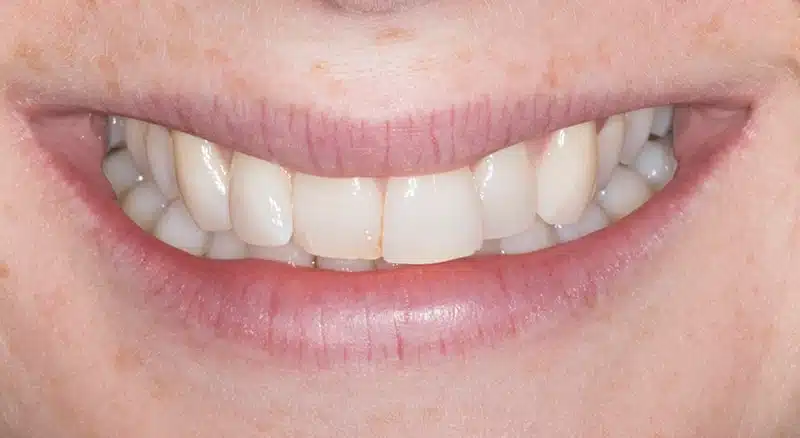 Front view of patient's smile before Invisalign Lite treatment showing mild front teeth crowding