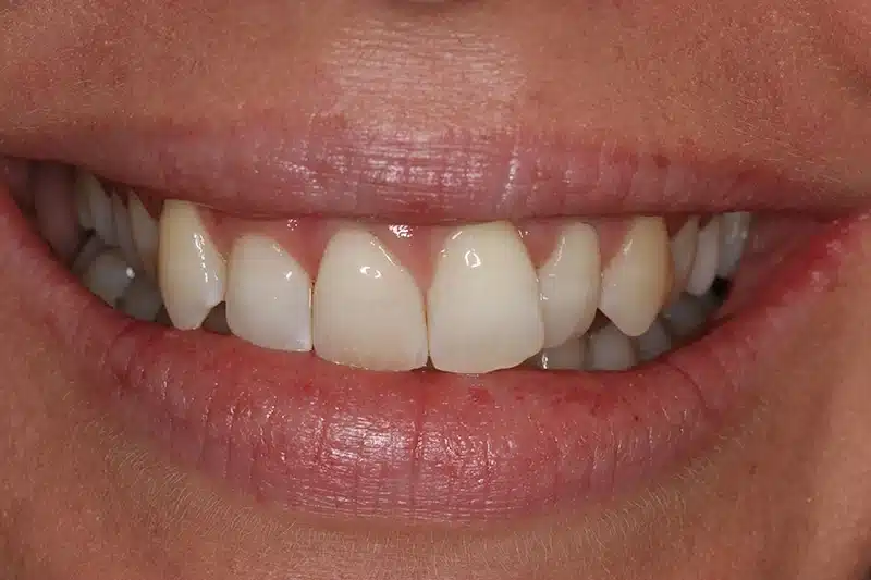 Patient smile before Invisalign treatment showing tilted front teeth and uneven smile alignment