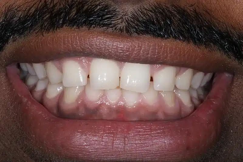 Patient smile before Invisalign treatment showing spacing around the front teeth