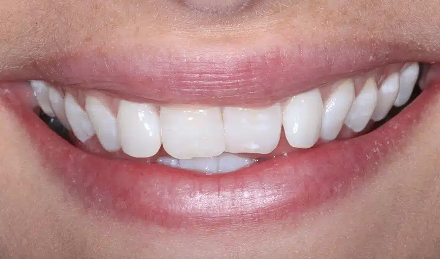 Front view of patient smile before Invisalign Lite treatment showing front teeth overlap
