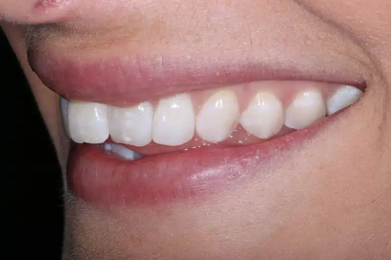 Side view of patient smile before Invisalign Lite treatment showing uneven front teeth