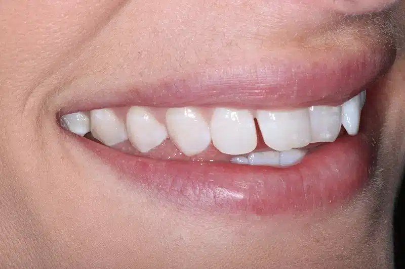 Side view of patient's smile before Invisalign Lite treatment showing front teeth overlap