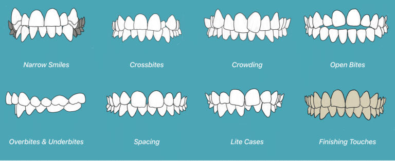 Clear Aligners vs. Braces: Understanding the Differences - Kanata South  Dental